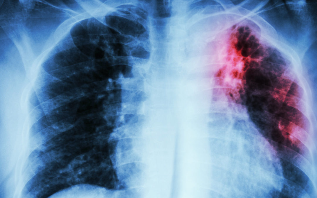 En lo que va de año han fallecido 37 personas por tuberculosis en Anzoátegui