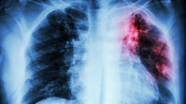 Alertan sobre incremento incontrolable de casos de tuberculosis en el país