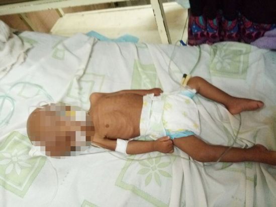 Murió otra niña por desnutrición en el estado Bolívar