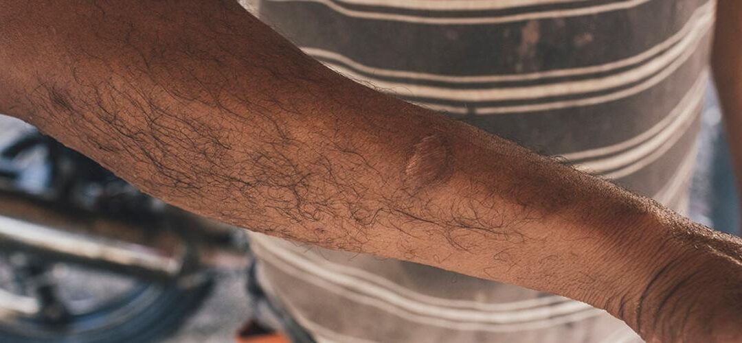 Hasta 250 dólares cuesta el tratamiento para Leshhmaniasis